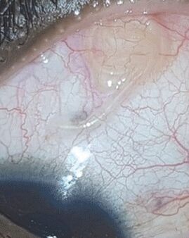 NEOflorax ayudó a deshacerse de un gusano en el ojo