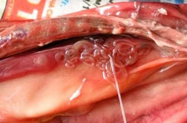 casualidad en la vesícula biliar